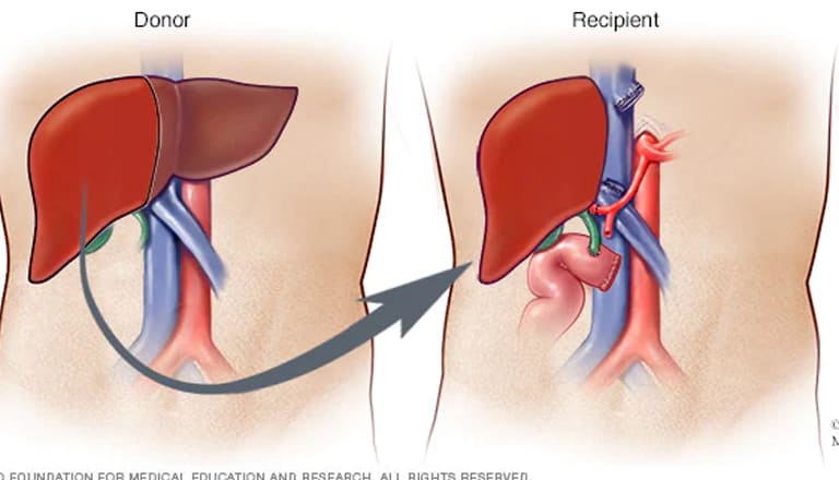 Liver-Transplantation-Surgery
